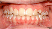 3 years after phase I center
