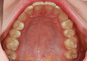 3 years after phase I occlusal