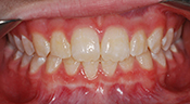 3 years after phase I tx