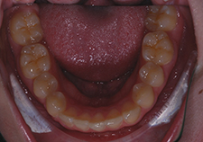 4 years later occlusal