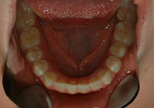 4.5 years after phase I man occl