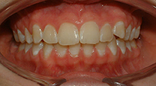 4.5 years after phase I