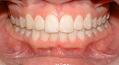 after perio surgery