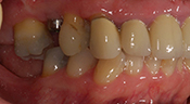 beginning buccal