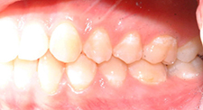 case 11 right