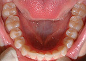 end of phase II ret man occl