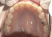 end phase I max occl