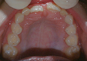 iniital occlusal