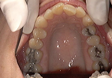 iniitial occl