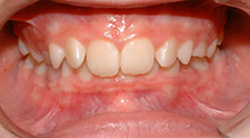 initial occlusal