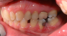 initiall buccal