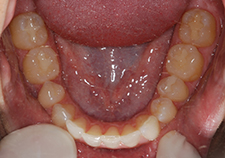 occlusal 7 years later