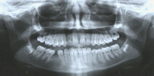 preortho pan