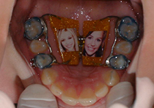 Palatal expander