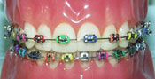 elastics