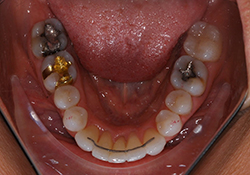 lingual retainer